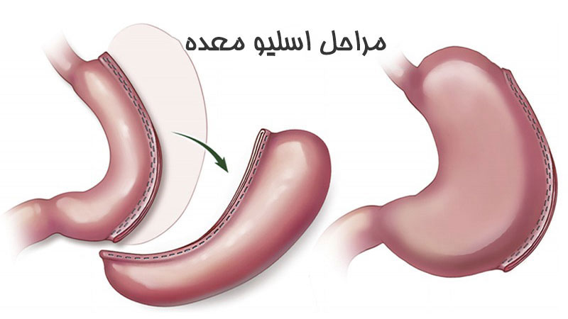 مراحل عمل اسلیو معده