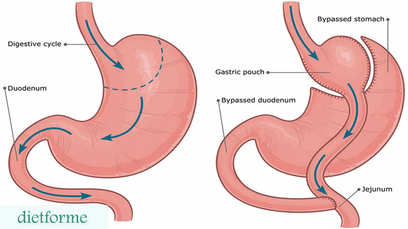 بای پس معده (Gastric Bypass)