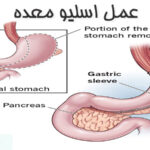 عمل اسلیو معده