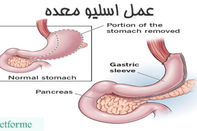 عمل اسلیو معده