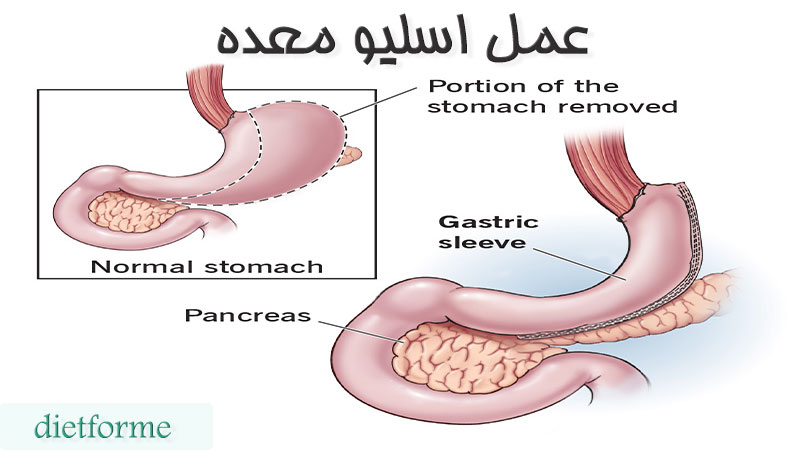 عمل اسلیو معده