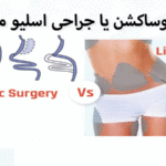 لیپوساکشن یا جراحی اسلیو معده