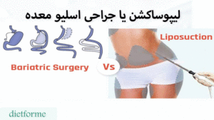 لیپوساکشن یا جراحی اسلیو معده